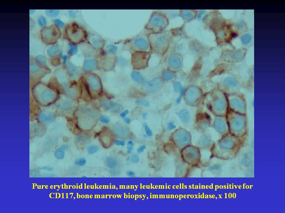 Fig. 8. Pure erythroid leukemia, many leukemic cells stained positive for CD117, bone marrow biopsy, immunoperoxidase, x 100